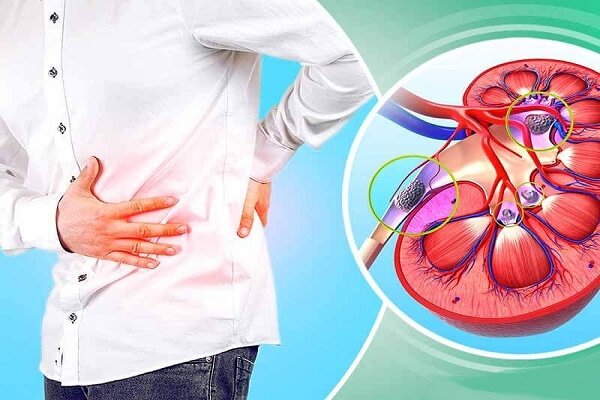 مصرف لبنیات سنگ سازی کلیه را کاهش می دهد